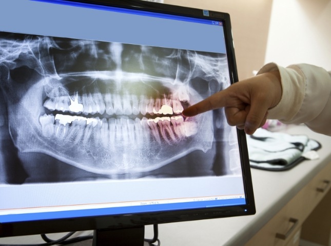 Dentist pointing to screen showing x rays of teeth