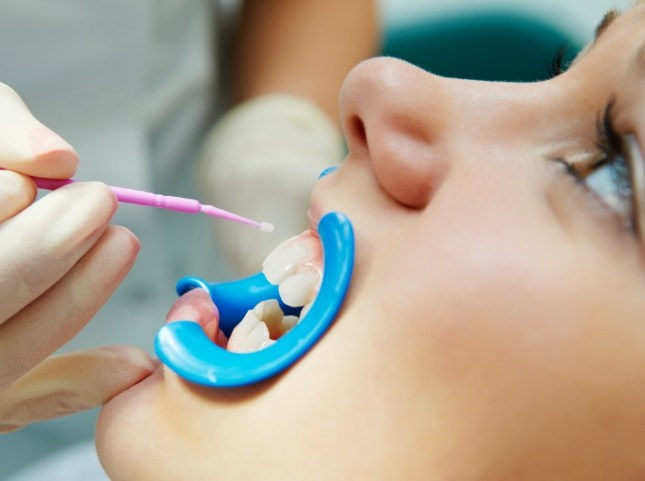 Dentist applying topical fluoride to a childs teeth