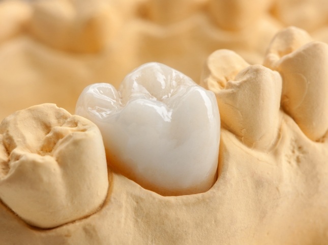 Dental crown over a tooth in a model of the mouth