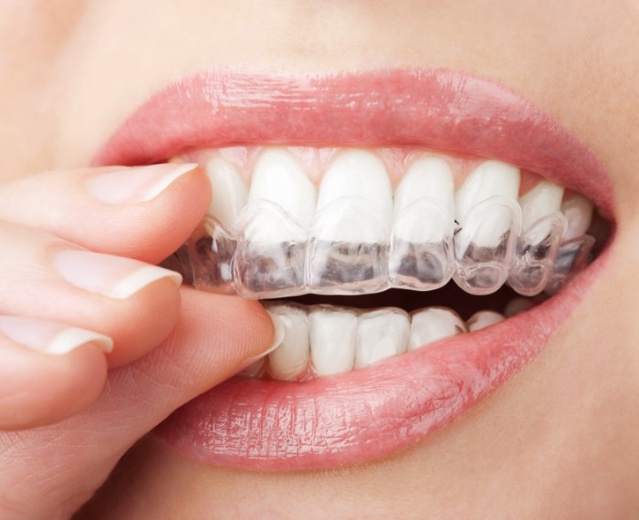 Close up of person placing Invisalign tray in their mouth