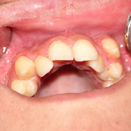 Close up of row of crowded teeth