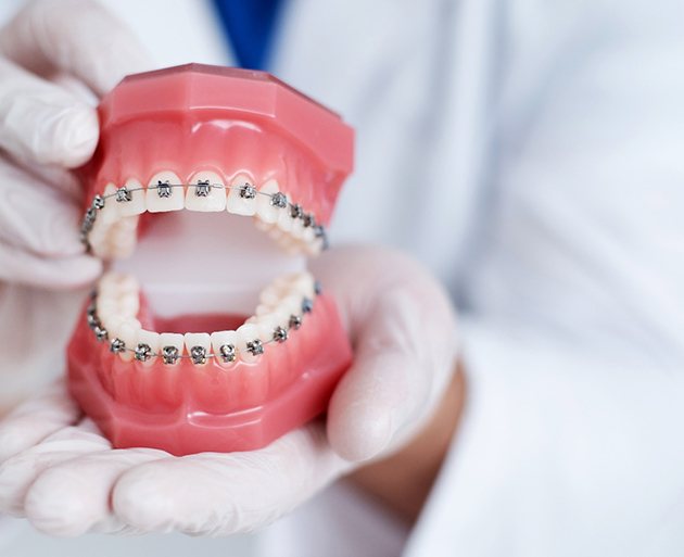 Dentist holding model teeth with braces with white gloves on