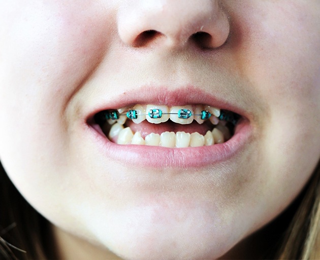 Nose-to-chin view of girl with crooked teeth and braces on top row
