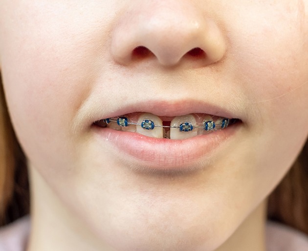 Nose-to-chin view of girl with gapped teeth and blue bands on braces